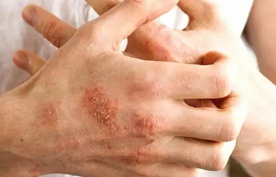 Bu havalarda egzamaya dikkat