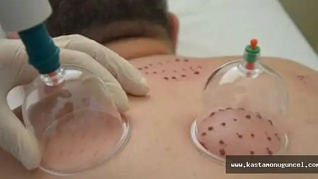 Hacamat Artık Hastanelerde Uygulanıyor