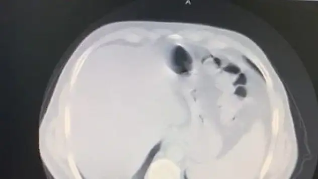 Koronavirüsü yenen doktor anlattı: Bilinç kaybı yaşadım...