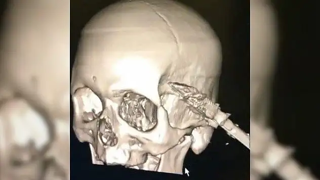 Uyuduğu sırada koltuktan düştü, başına soba maşası saplandı