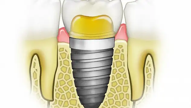 İmplant ile ilgili merak edilen 6 soru