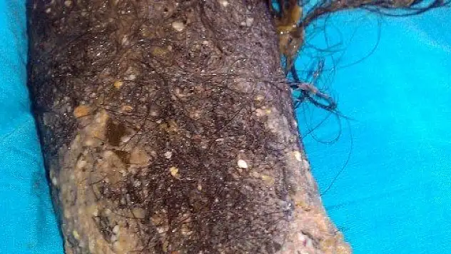 Yemek yiyemeyen genç kızın midesinin saçla dolu olduğu ortaya çıktı