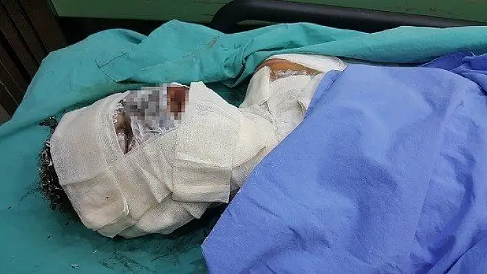 Sobaya dökülen tiner parladı, lise öğrencisi hastanelik oldu