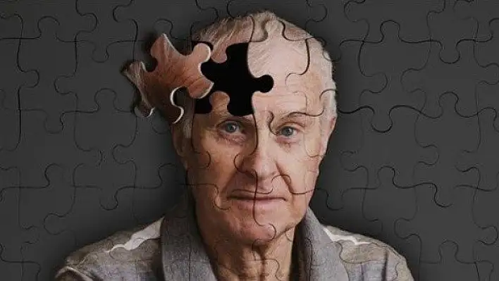 Alzheimer hastalığı ilk belirtilerden 20 yıl önce başlıyor