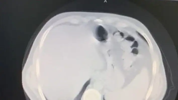 Koronavirüsü yenen doktor anlattı: Bilinç kaybı yaşadım...