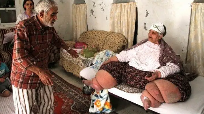 Fil hastalığı yüzünden 9 yıldır gün ışığı görmedi